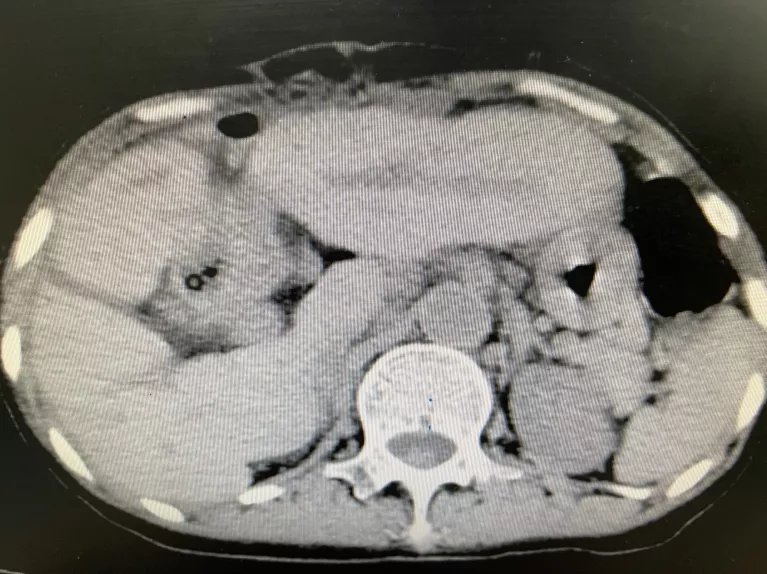 蛔虫|重234克直径12厘米！世界上最大的单颗胆总管结石成功摘除