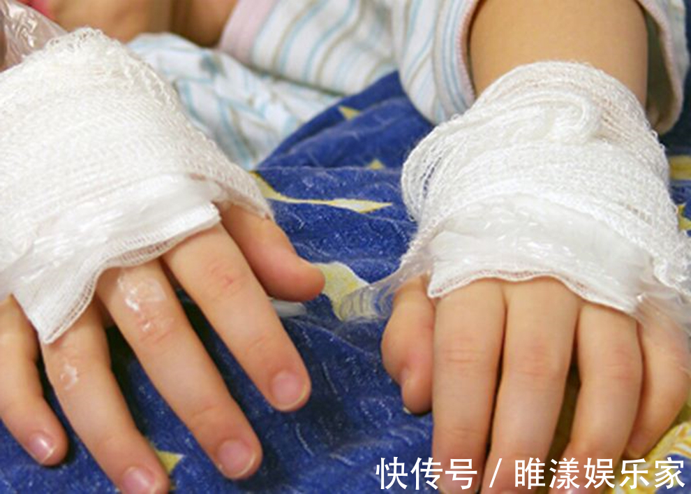 薯条|4岁孙子掉入150度油锅,奶奶的处理太及时,医生多亏奶奶专业