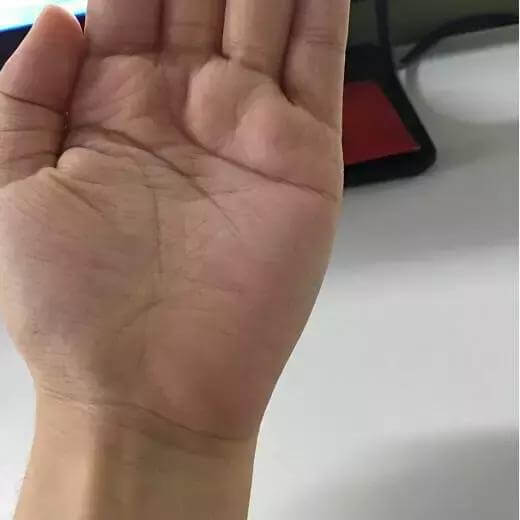 有没有|这条糖尿病线,你手上有没有如果看到它,请注意了