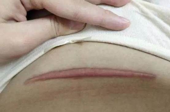 性生活|剖腹产的伤口,对女性身体会不会产生伤害,妇产科医生说出真相