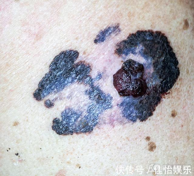 鳞状细胞癌|皮肤癌并非“悄无声息”身上有这些异常,疾病已至