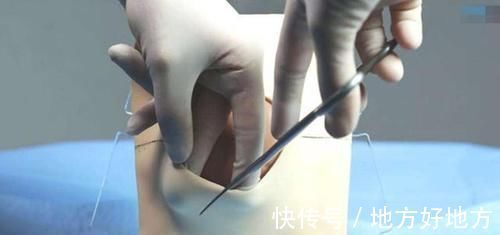 会阴|明明是顺产,还要挨一刀,产科医生避免侧切,做好这5点很重要