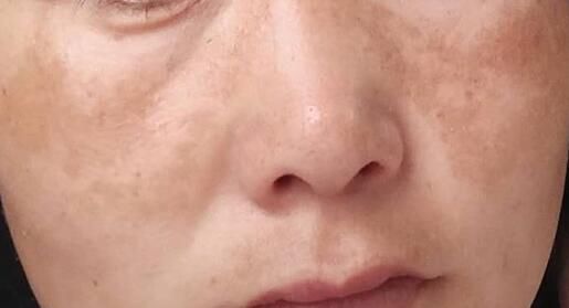 后果|全民护肤日：这些后果严重的皮肤病，却常常被忽视