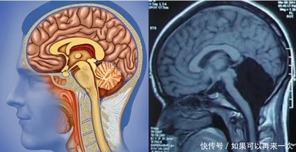 小脑性共济失调的临床表现