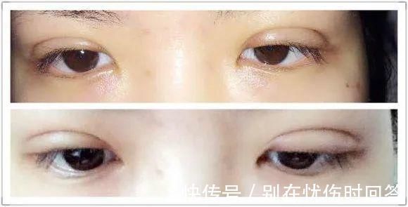 肉条感|双眼皮术后出现肉条的不同原因和修复方法