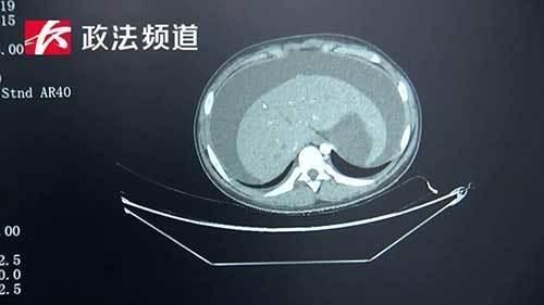 普外一科|12岁女孩肚大如怀孕，半个月内体重暴增14斤真相竟是这样