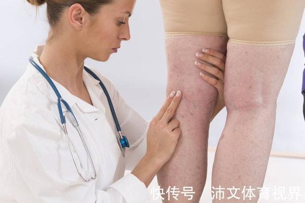 降血脂|体内血脂高,腿部先知!腿部若有这4种迹象,需及时降血脂