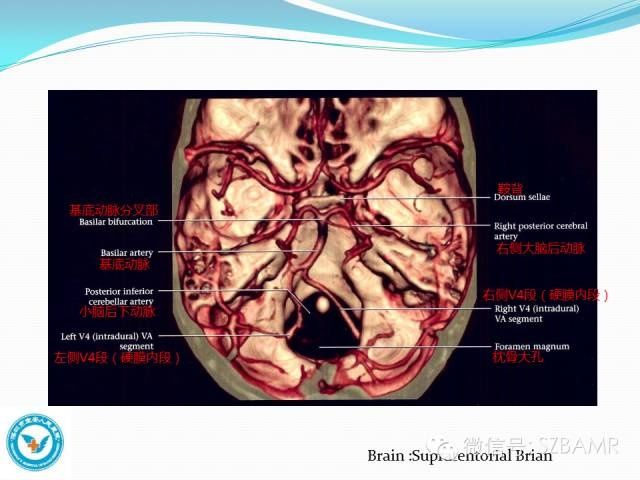 mr|椎-基底动脉系统解剖