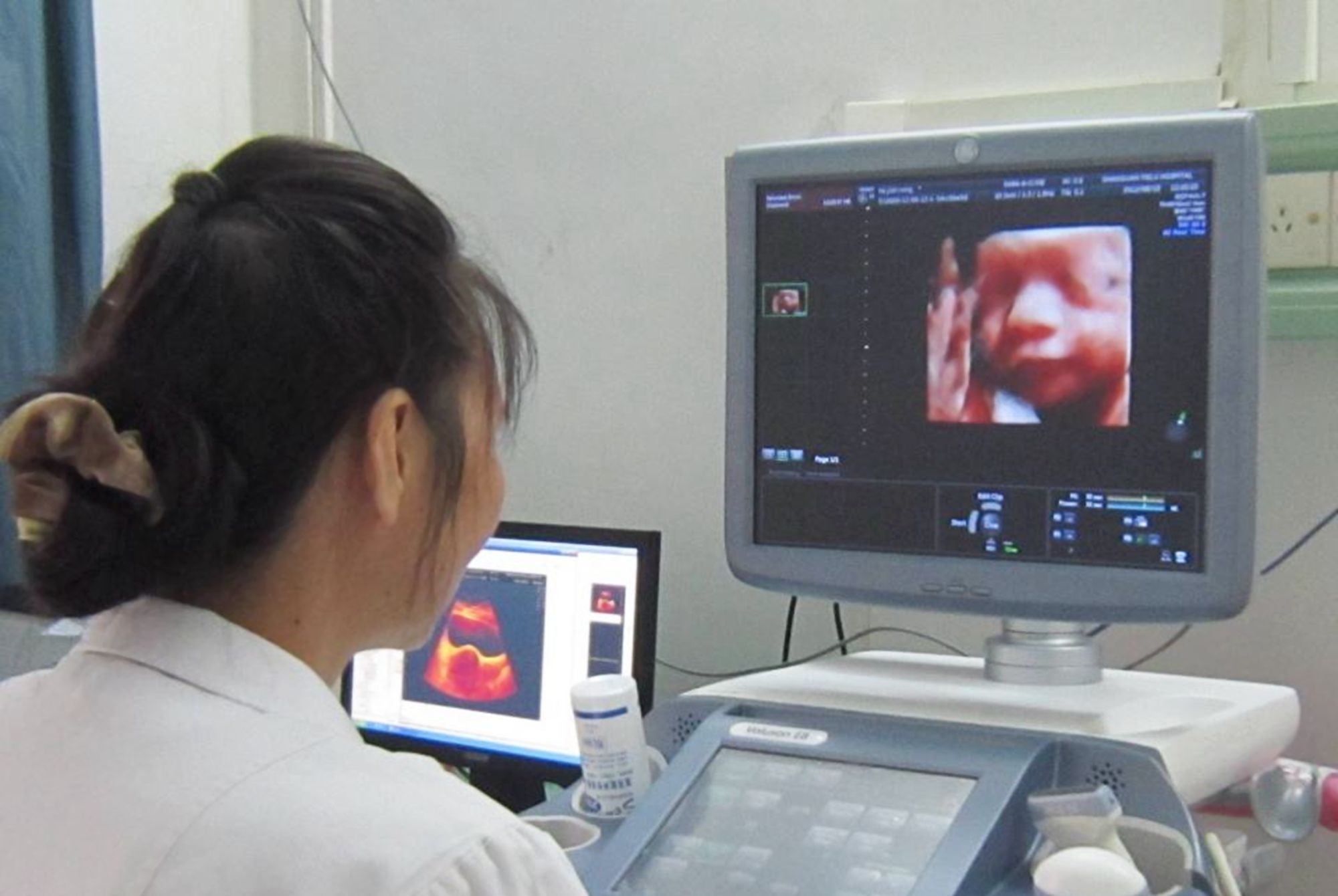 四维彩超|产检做四维彩超,为什么“家属勿入”?其实是出于“三保护”原则