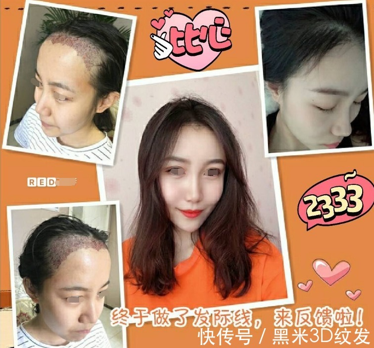 脱发者 黑米3D纹发:关于植发的一些事实《5-8》