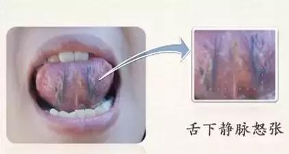 舌诊|中医医生总看舌头都在看什么九种体质+珍贵的舌诊图谱