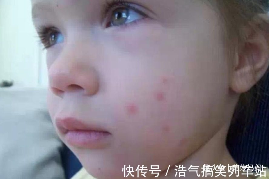 花露水|宝宝被蚊子叮咬后,第一步不是帮娃止痒,很多家长都做错了