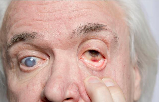 得了糖尿病,可能会出现5个并发症,坚持4个习惯,或能及时预防