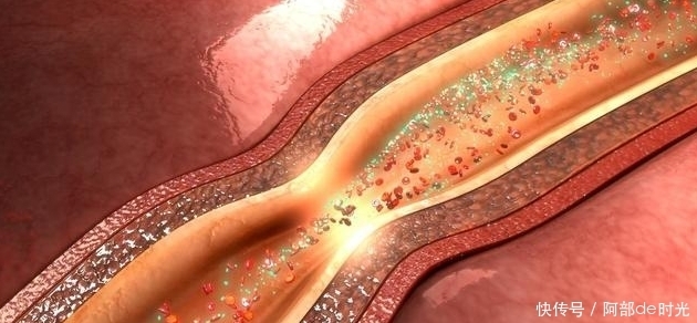 反式脂肪酸|血管为什么一年比一年堵?常吃2种食物,给血管“洗洗澡”