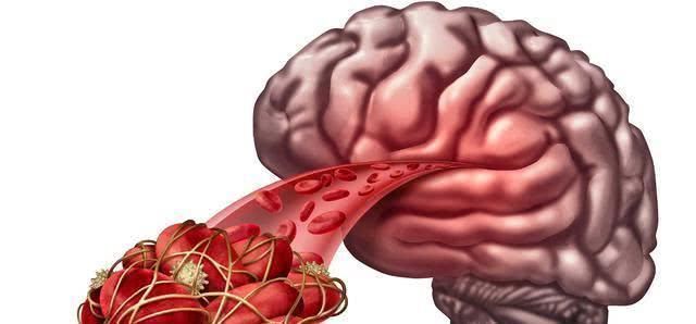 心脑血管|脑血栓的天然“清道夫”, 坚持每天吃一点, 远离血栓更健康!