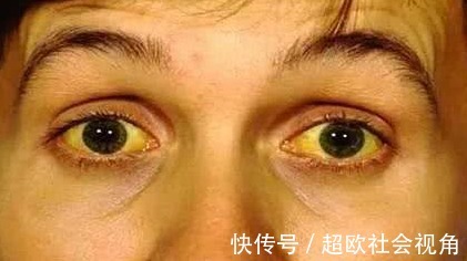 症状|身体有这6个症状,说明肝脏早已“烂透”,尽早戒酒