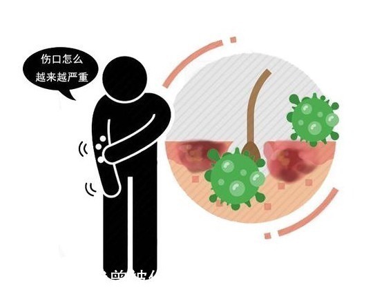 部位|哪种“痣”是危险分子?医生提醒:长在这3处的痣,要格外当心