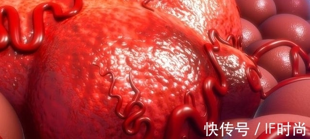 复发|这5种癌症,术后最容易复发和转移!如何预防?这3点牢记在心中