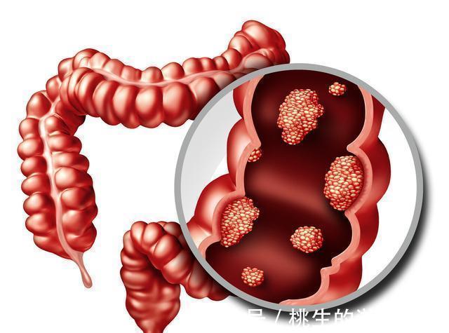 常见病|什么病会转为癌症?医生列举出了4种常见病
