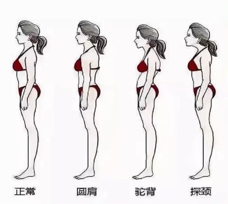 上交叉综合症|杭州美莱：怎么让你的背影比20+的女生还要纤薄挺拔？