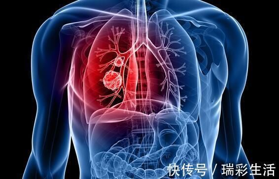 癌细胞|出现这种咳嗽, 别以为是感冒问题, 它可能是肺癌发出的信号!