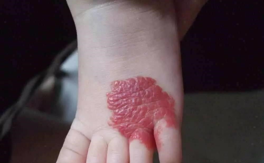 孕期|那个脸上有“蝙蝠”胎记的女孩,如今生活的怎么样?看完很欣慰