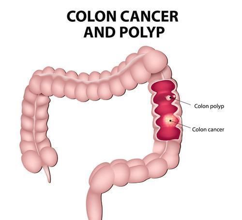 癌前病变|医生提醒5种常见病,其实是癌前病变很少人愿意去医院治