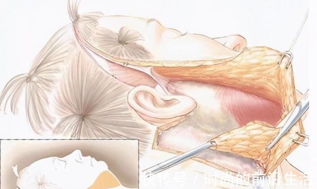 求美者 做了“假拉皮”手术,危害有多大!