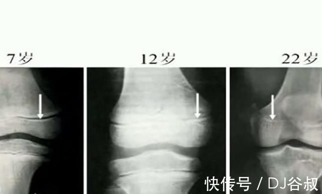 强身健体|为长高,妈妈每天逼女儿跳绳3000个,跳出骨骺炎后,妈妈自责不已