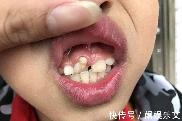 营养均衡|6岁孩子长出双排牙，医生询问原因后才得知：都是精细喂养惹的祸