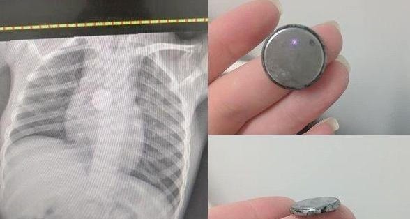 孩子|5岁女孩暴瘦!医生让女孩“摘下项链”,妈妈惊呼女儿没戴项链