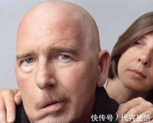 头晕头痛|一旦头上出现三种异常,说明体内有血栓了,常吃5物,脑梗不扰