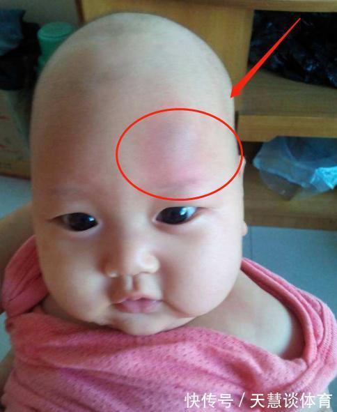 睡觉时间|孩子头部摔伤后,妈妈第一时间的做法,连医生都夸赞