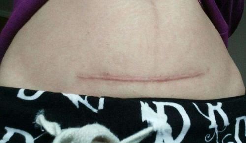 子宫|剖腹产没半年又怀孕,孕30周后子宫破裂,大人保住了孩子却没了