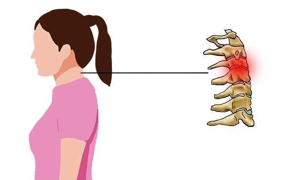 身体|女性45岁后容易骨质疏松,一旦骨质疏松,身体会提醒你,要早补钙
