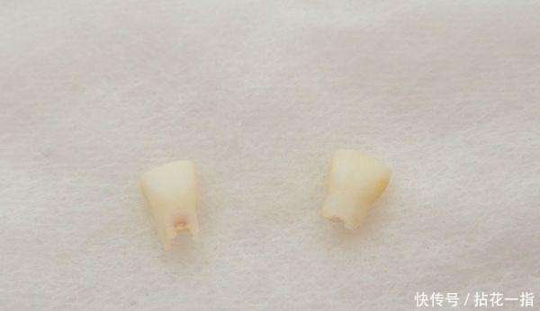 纱布|宝贝不害怕,儿童换牙的心理建设与拔牙方式!