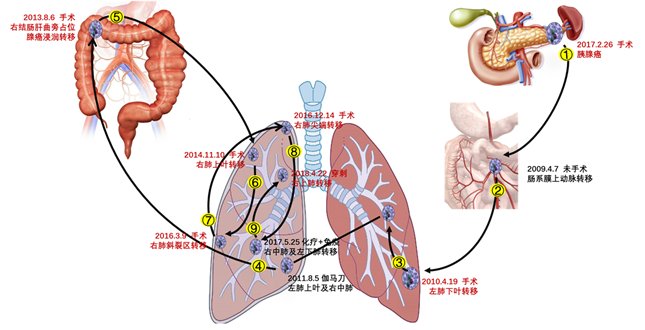 张俊|胰腺癌活不过1年？这位老太太复发6次，如何带瘤生活超10年？