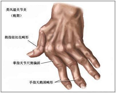 炎症|风湿性关节炎的几种表现