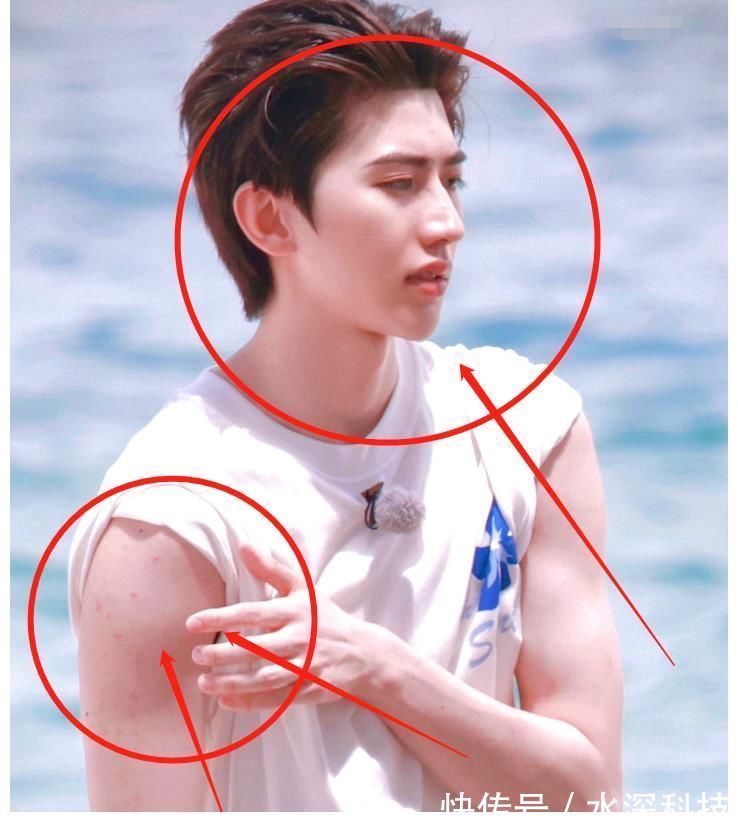 跑男|蔡徐坤参加跑男，大夏天穿羽绒服引关注，手臂上的红疹却让人心疼