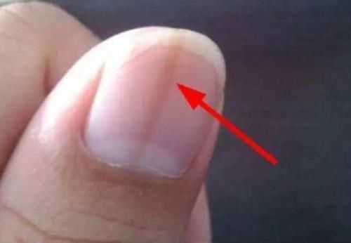 疾病|指甲有竖纹是疾病的表现吗?离不开这4个问题,越早知道越好!