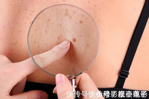 饮水量|肝硬化来临时,通常会有这4种异常,占一个,也要引起注意