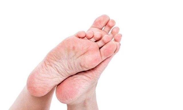 “脚后跟干裂”是什么原因导致的?你遇到过这种情况吗?别忽视!