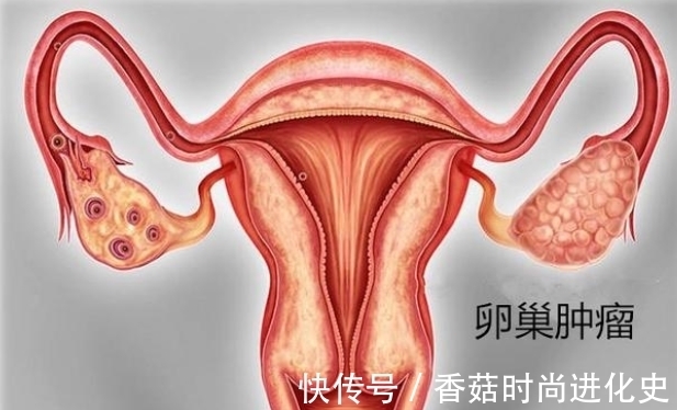 腹膜癌|女人年过40岁，很多妇科疾病会找上门，对于卵巢肿瘤如何预防呢