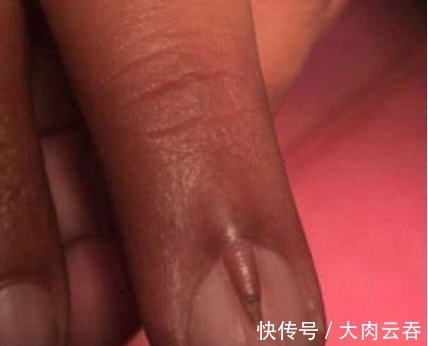 指甲|男子的指甲上长出“小手指”,去医院检查后,医生也是第一次看到