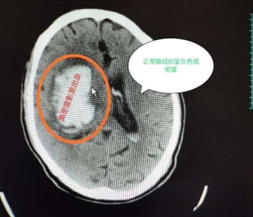 患者|血压达到多少，就会导致脑出血？医生告诉你导致脑出血的主要原因