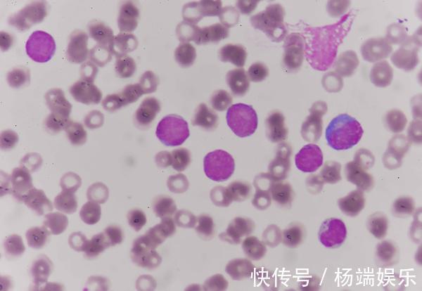 患者|癌症晚期是否要治,是不是不值得治医生说出了大实话!