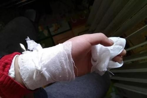 伤口|孩子烫伤后只有2分钟紧急处理,做错这一步,可能加重孩子的伤情