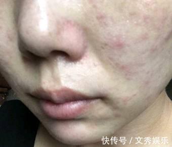 高血糖|血糖高不高,看脸就知道!若面部没4种表现,血糖还算稳定,恭喜