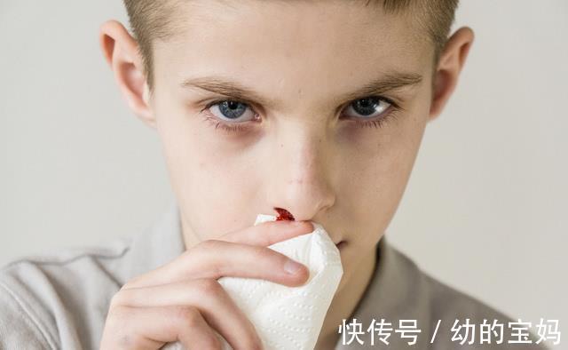 动作|3岁男孩鼻出血因一个错误动作去世,医生提醒:应该这样正确应对