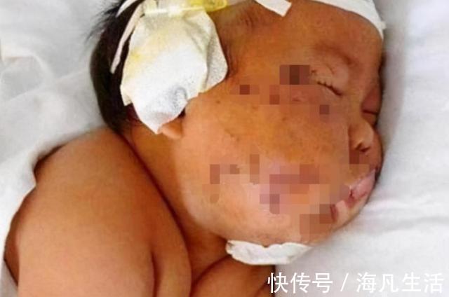 宝宝|5年前因吃奶太用力,被妈妈刮成“花脸猫”的宝宝,如今怎么样了